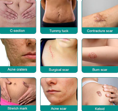 🔥Buy 3 Get 3 Free🔥Advanced ScarRemoval Spray